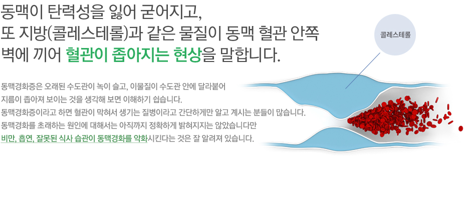 동맥이 탄력성을 잃어 굳어지고, 또 지방(콜레스테롤)과 같은 물질이 동맥 혈관 안쪽 벽에 끼어 혈관이 좁아지는 현상을 말합니다. 동맥경화증은 오래된 수도관이 녹이 슬고, 이물질이 수도관 안에 달라붙어 지름이 좁아져 보이는 것을 생각해 보면 이해하기 쉽습니다. 동맥경화증이라고 하면 혈관이 막혀서 생기는 질병이라고 간단하게만 알고 계시는 분들이 많습니다. 동맥경화를 초래하는 원인에 대해서는 아직까지 정확하게 밝혀지지는 않았습니다만 비만, 흡연, 잘못된 식사 습관이 동맥경화를 악화시킨다는 것은 잘 알려져 있습니다. 